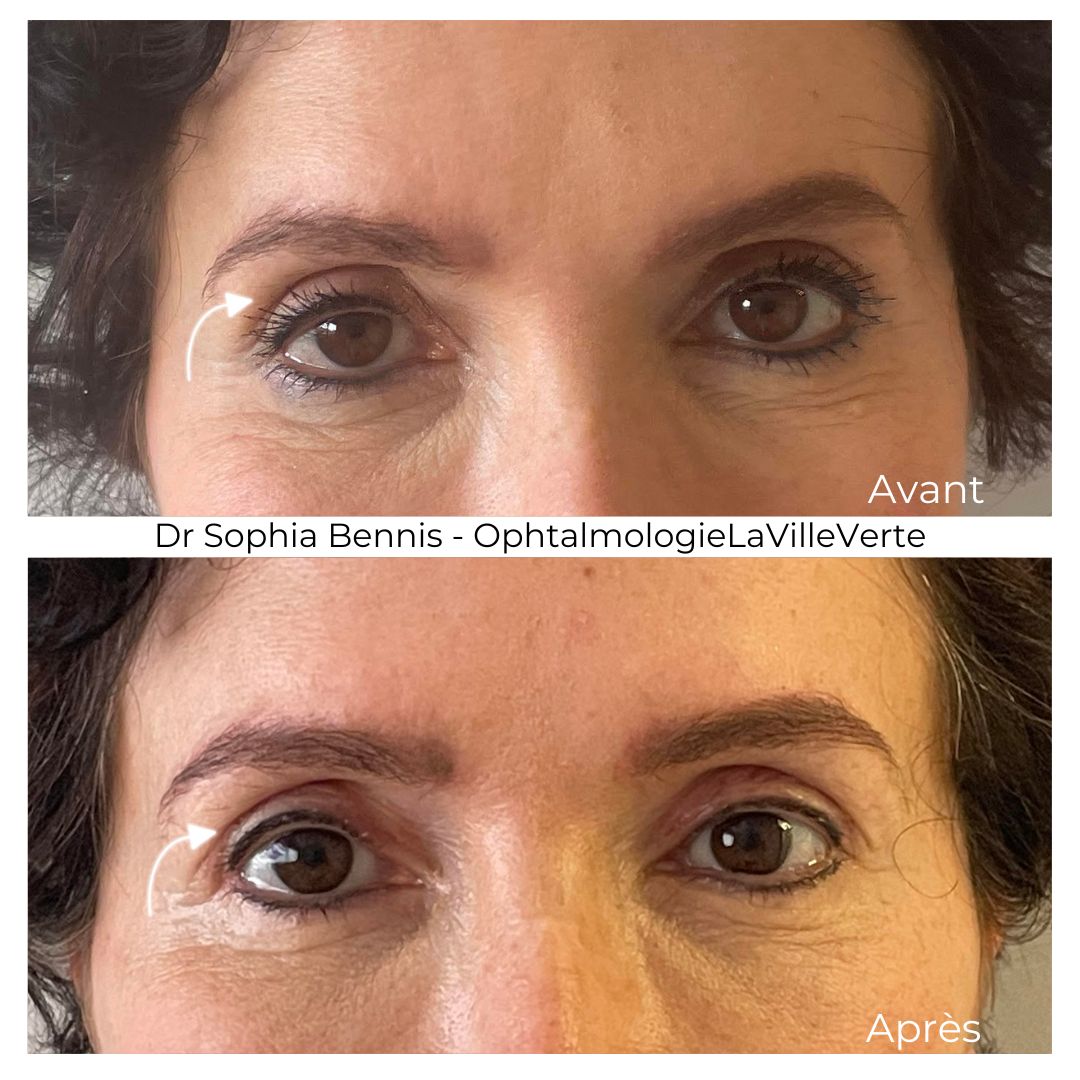 Avant / après : Chirurgie du ptosis