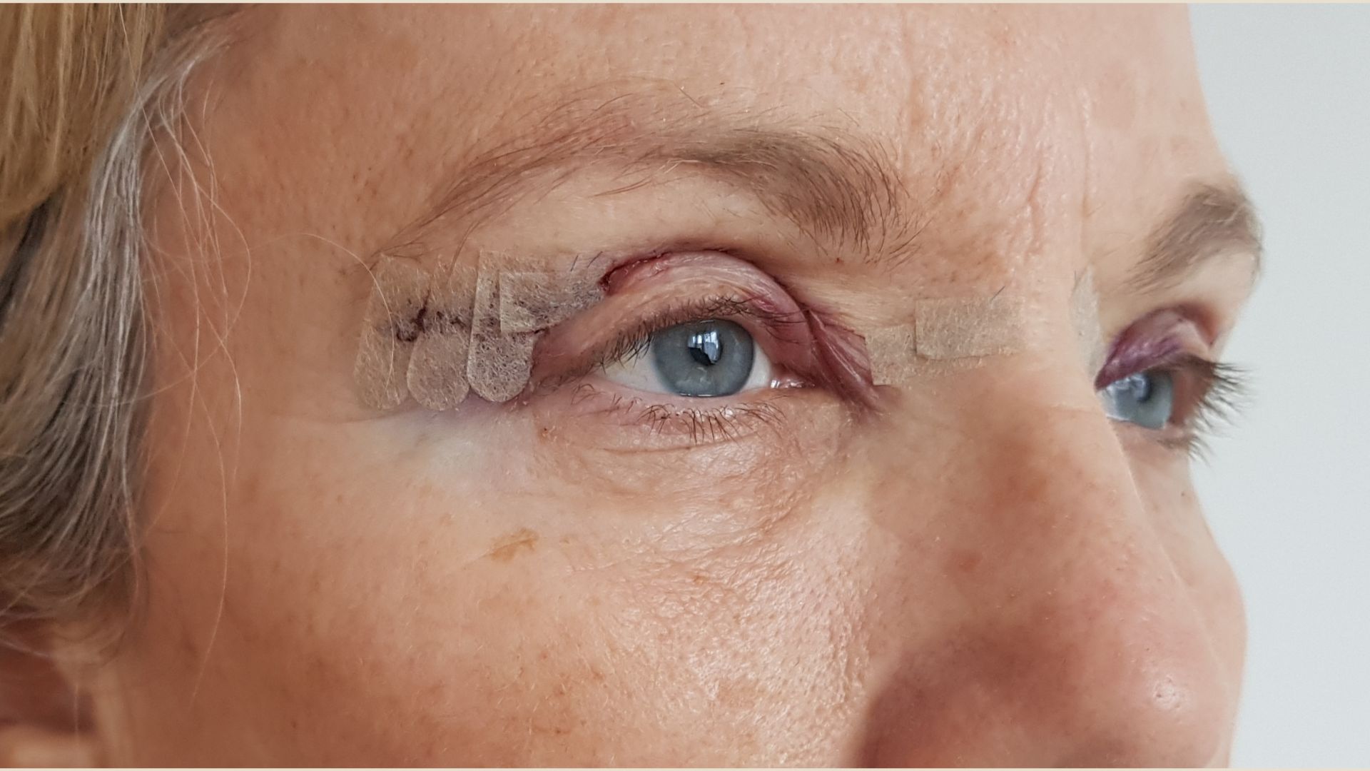 Blépharoplastie