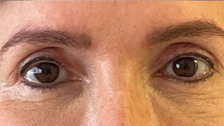 Ptosis (paupière tombante)